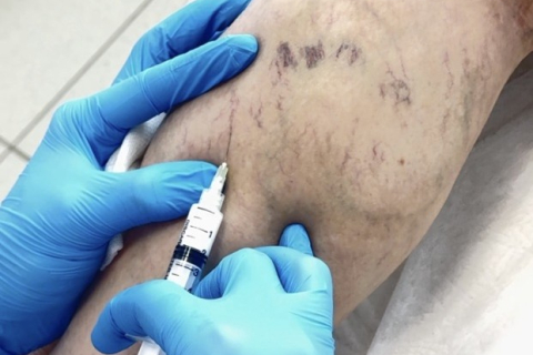 Когда необходимо лечение сосудистых звездочек