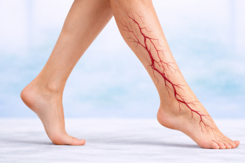 Почему тянет вены на ногах вечером - это уже варикоз?